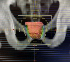 radioterapia-3d-conformada